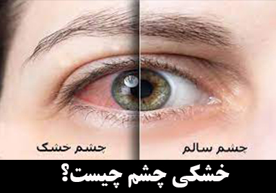 خشکی چشم چیست؟