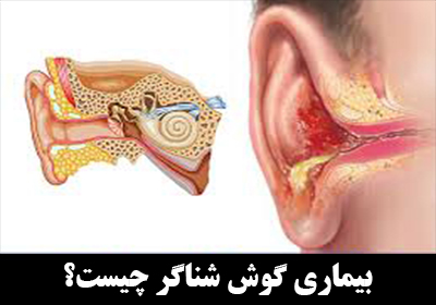 بیماری گوش شناگر چیست؟