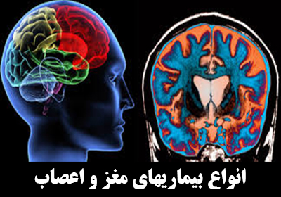 انواع بیماریهای مغز و اعصاب