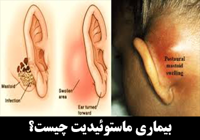 ماستوئیدیت یا عفونت استخوان گوش چیست؟