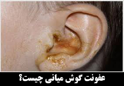 عفونت گوش میانی (Middle ear infection) چیست؟
