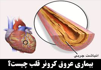 بیماری عروق کرونر قلب چیست؟